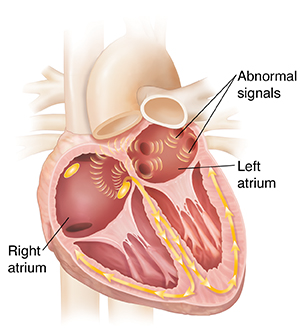 Cross-section of heart with atrial fibrillation, showing abnormal signals in left and right atria..