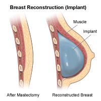 Click Image to Enlarge Illustration of a breast side view, before and after reconstruction (Implant)