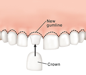 Crown being placed on shaped tooth. Dotted line shows new gumline.