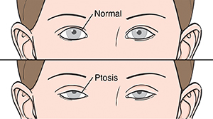 Normal open eyes compared with ptosis. Eyes with ptosis appear to be partly shut.