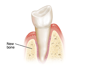 Tooth in cross section of gum and bone. New bone has grown where graft was placed.