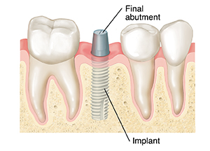 Teeth in cross section of gum and jawbone. Implant is in bone, and final abutment is attached to implant above gum.