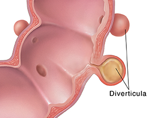 Cross section of sigmoid colon showing diverticulitis.