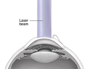Cross section of eye showing laser beam reshaping cornea under flap.