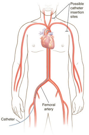 Front view of male figure showing cardiovascular system with catheter inserted in femoral artery to heart. Other possible catheter insertion sites shown.