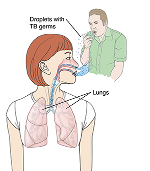 Outline of woman's head and chest with head turned to side. Inside of nose, airway, and lungs are visible. Man in background is coughing out droplets with TB germs. Droplets are being breathed in to woman's nose and lungs.