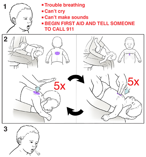 3 steps for doing the Heimlich maneuver on a baby