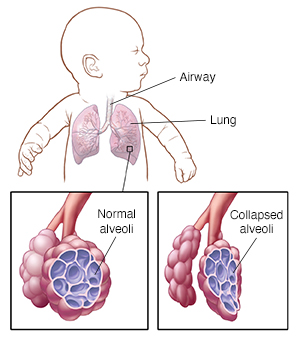 Baby with head turned to side showing airway and lungs. Closeup of airway and normal alveoli. Closeup of airway and collapsed alveoli.