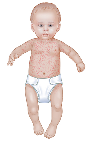 Infant with roseola rash on neck, arms, and torso.