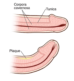 Cross section of penis without Peyronie disease and of curved penis with Peyronie disease.