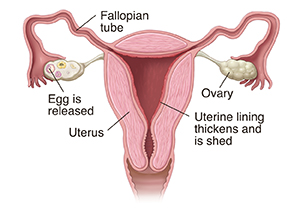 Reproductive organs related to menstruation showing uterus, ovaries, a released egg, fallopian tube, and thickened uterine lining.