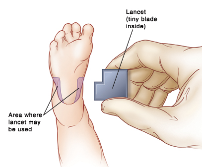 Bottom of baby's foot with areas on either side of heel shown where lancet may be used. Hand holding lancet which has tiny blade inside.