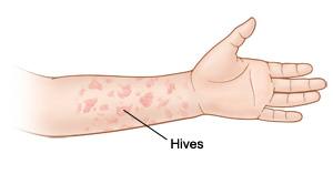 Hand and forearm with hives.