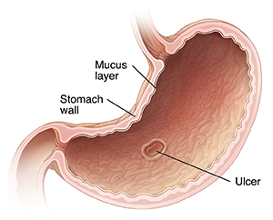 Cross section of stomach showing ulcer in mucus layer.