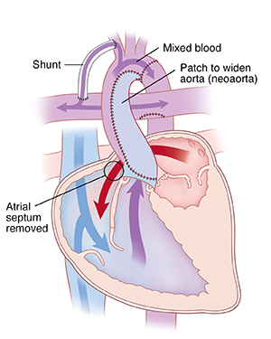 Cross section of heart showing Norwood procedure.