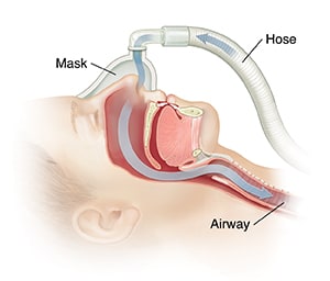 Side view of head with arrow showing path of air through CPAP mask into nose and airway.