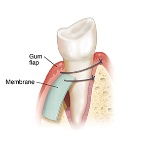 Membrane being placed in gum flap next to tooth.