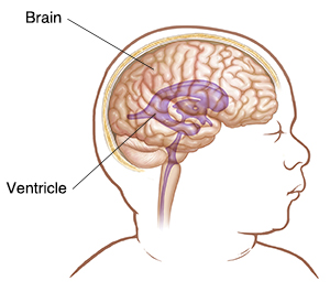 Side view of infant's head showing brain and ventricle.