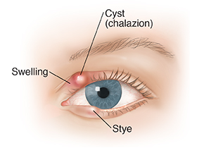 Front view of eye showing blepharitis.