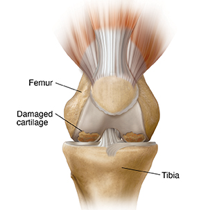 Front view of knee showing osteoarthritis.