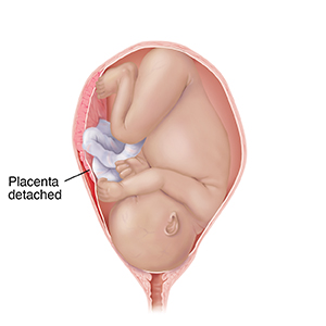 Front view of full-term fetus in uterus in pelvic bones with head down. Placenta is detached from wall of uterus showing placental abruption.