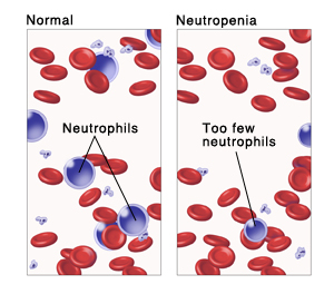 Microscopic blood sample showing normal number of neutrophils. Microscopic blood sample showing too few neutrophils.