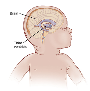 Side view of baby's head showing third ventricle in brain.