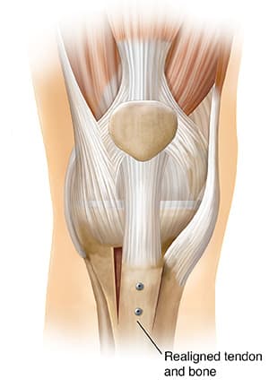 Front view of knee joint showing kneecap realignment.