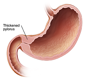 Cross section of stomach with thickened pylorus.