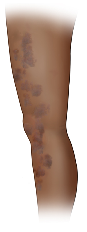 Rash on dark-skinned leg.
