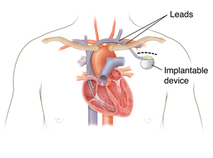Outline of man's chest showing pacemaker in chest with leads going into heart chambers.