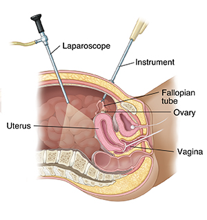 Sideview cross section of female pelvis showing reproductive laparoscopy.