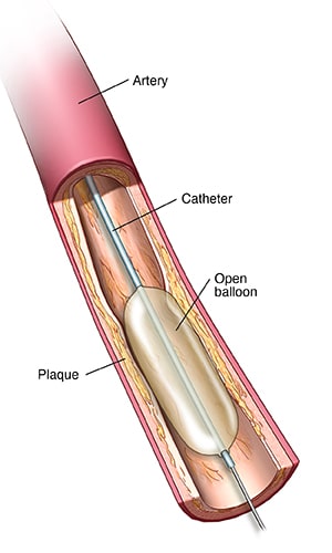 Partial cross section of artery showing balloon catheter inserted next to plaque buildup and inflated.