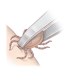 Closeup of tweezers removing tick from skin.