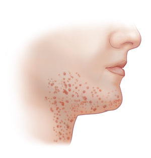 Folliculitis on light skin.