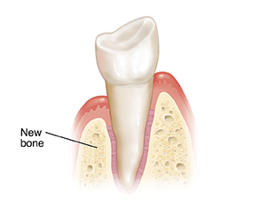 Tooth in cross section of gum and bone. New bone has grown where graft was placed.