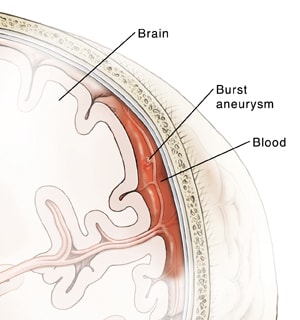 Cutaway view of ventricles showing enlarged ventricles and subarachnoid space.