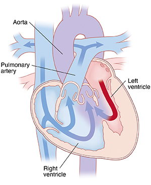 Heart showing DORV, arrows show blood flowing from right ventricle to pulmonary artery and aorta.