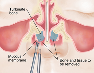 Front view of face showing surgical instruments removing part of turbinate bone in nose. 