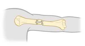 Comminuted fracture of upper arm bone, showing four separate bone pieces.