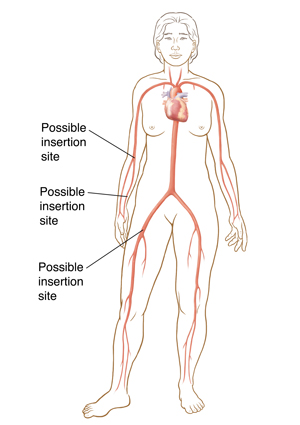 Front view of woman showing catheter insertion sites in groin and arm.