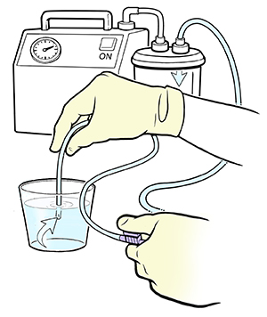 Gloved hand dipping tip of tracheostomy suctioning tube into cup of saline solution.