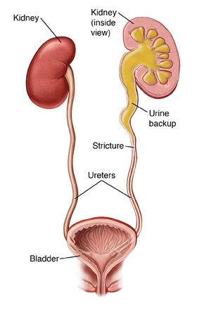 Front view cross section of kidneys, ureters, and bladder. Left ureter is closed off with urine backing up into kidney.