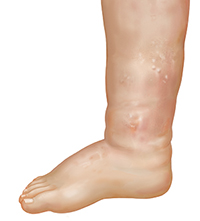 Side view of leg showing ankle and foot swelling.
