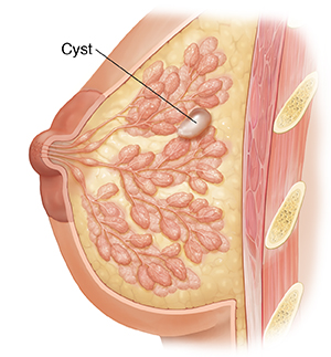 Cross section of breast with cyst and chest wall.