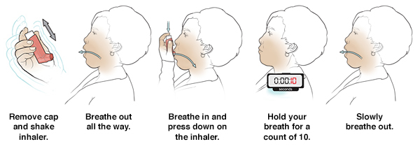 Five steps in using metered-dose inhaler without a spacer.