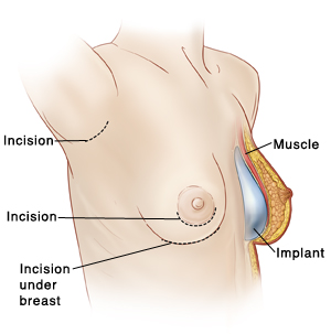 Three-quarters view of female chest showing breast implant incisions on right and cross section of left breast showing implant in place.