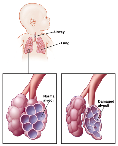 Baby with head turned to side showing airway and lungs. Closeup of airway and normal alveoli. Closeup of airway and damaged alveoli.