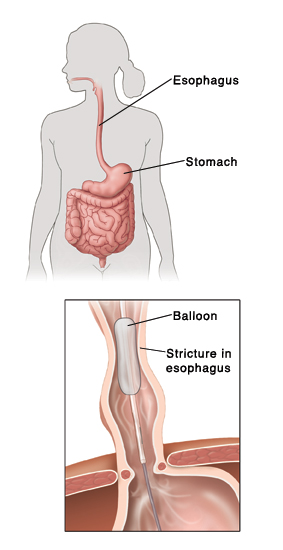 Outline of human figure showing digestive system. Inset shows balloon widening stricture in esophagus.