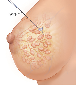 Side view of female breast with ducts and lobules ghosted in showing wire going through skin into lump.